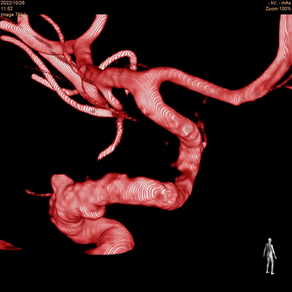 Primer caso de tratamiento de aneurisma cerebral con stent diversor de ...