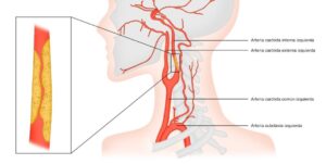 estenosis arterias carótidas