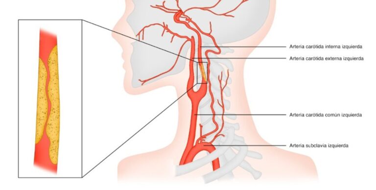 estenosis arterias carótidas
