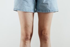 Piernas hinchadas y varices después del verano, señales que no debemos normalizar.