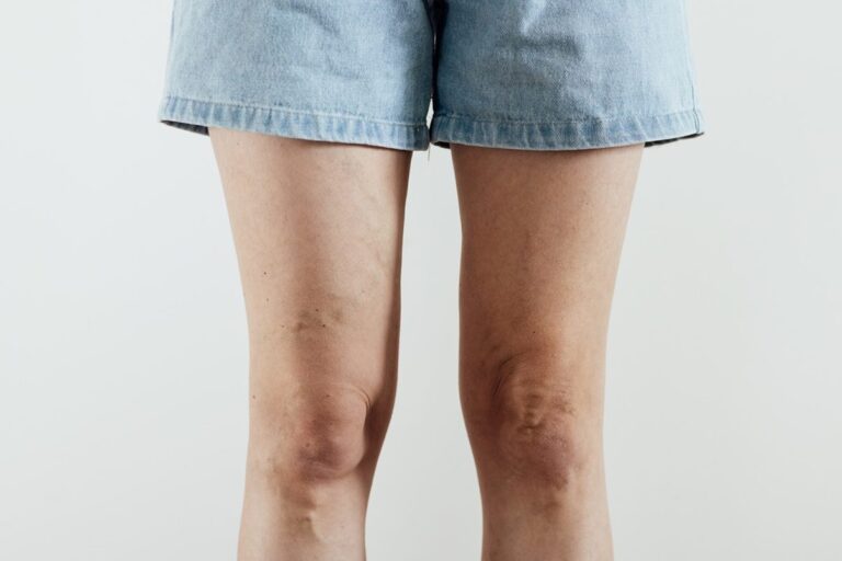 Piernas hinchadas y varices después del verano, señales que no debemos normalizar.